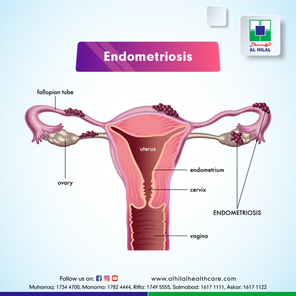 Endometriosis