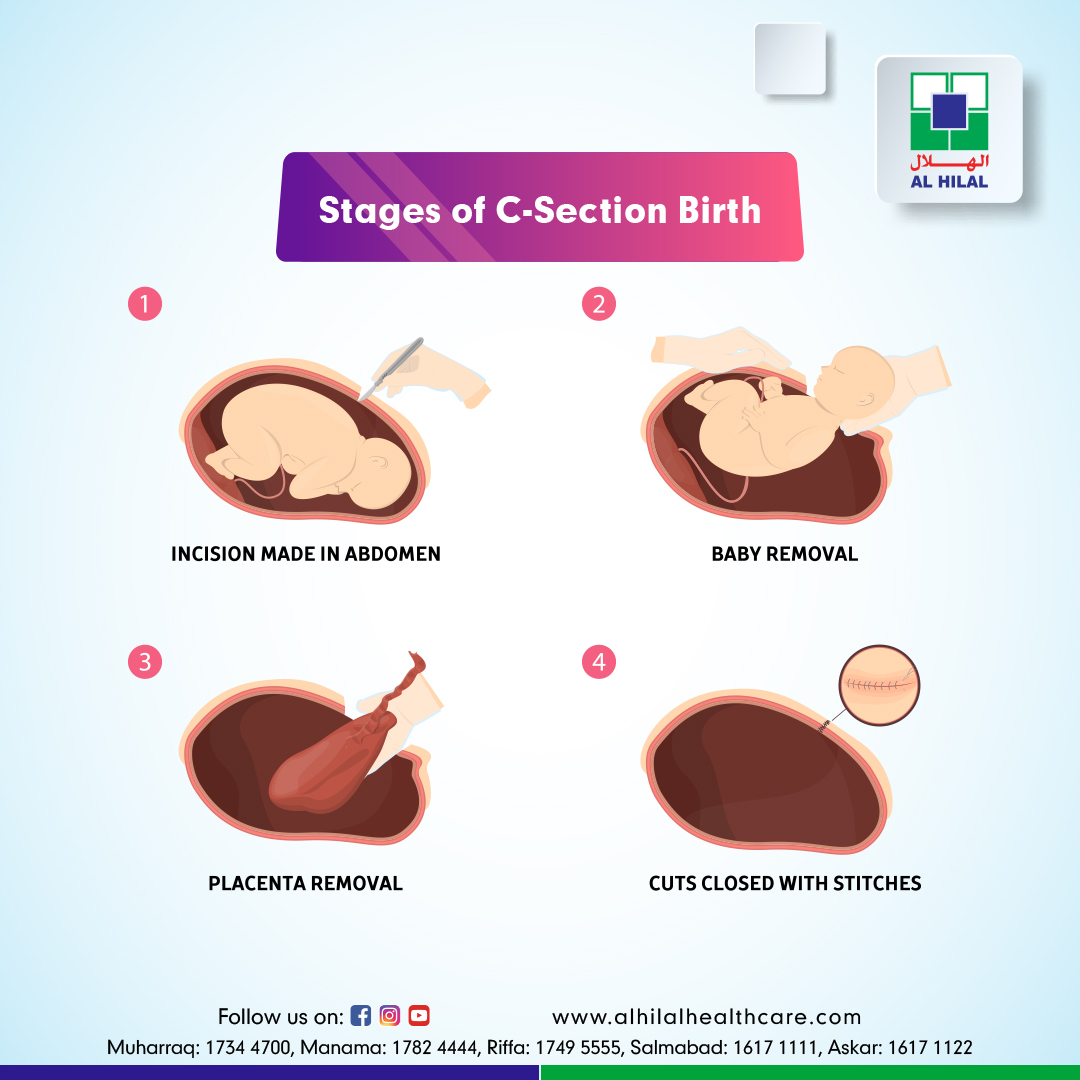 Cesarean Section 5117