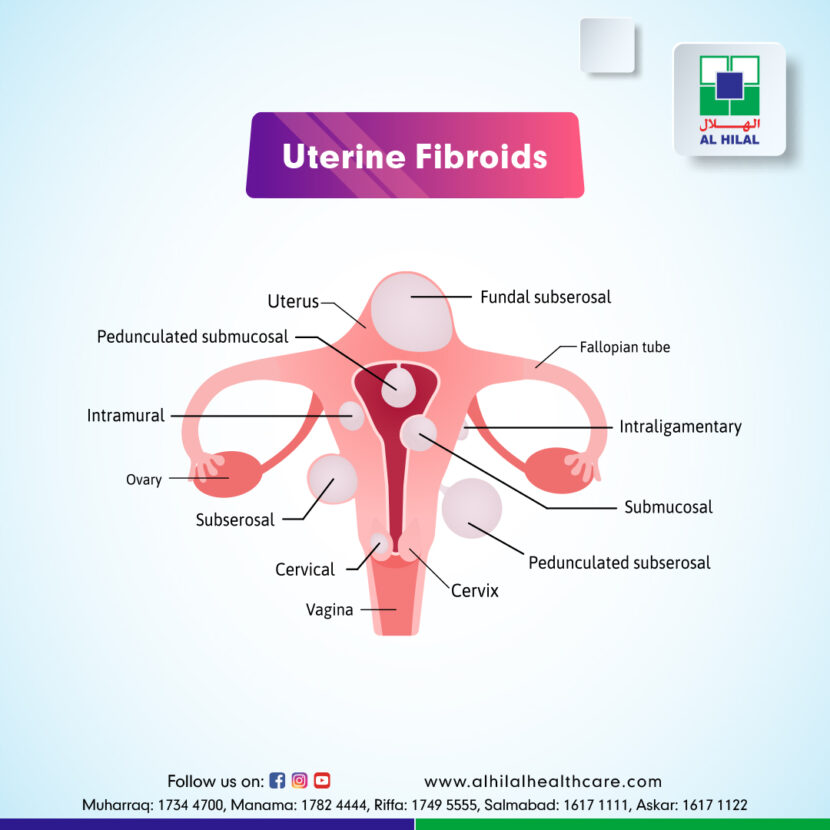 Uterine Fibroids