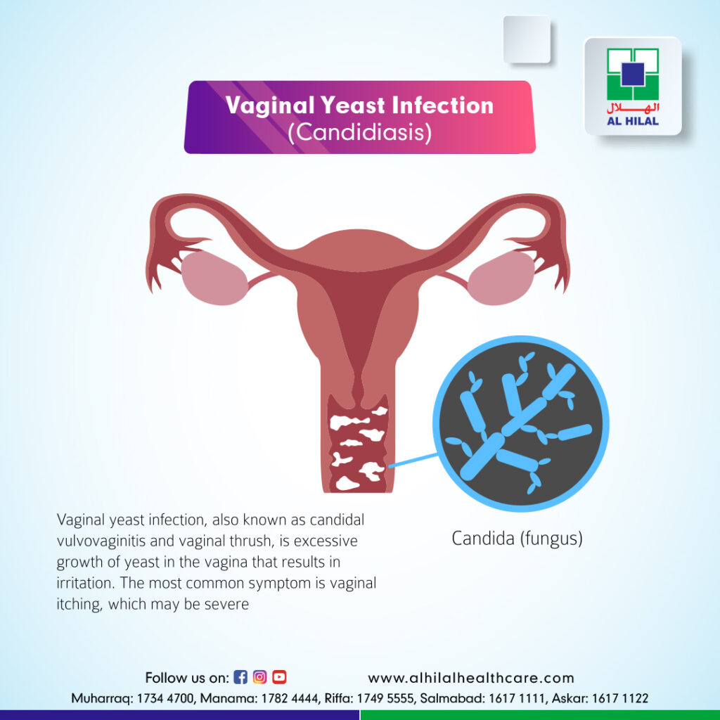 candidiasis vaginal treatment