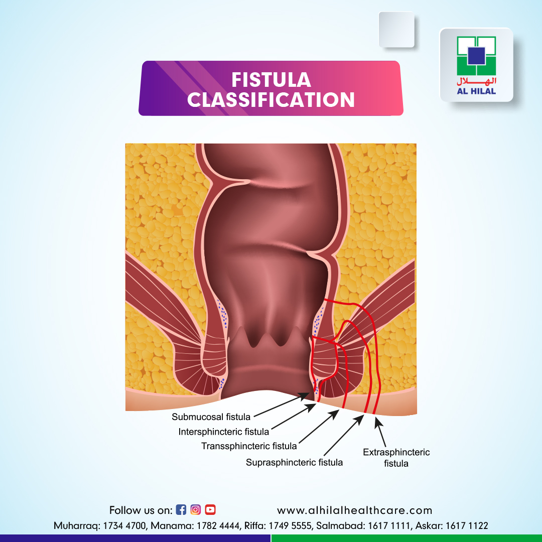 FISTULA IN ANO