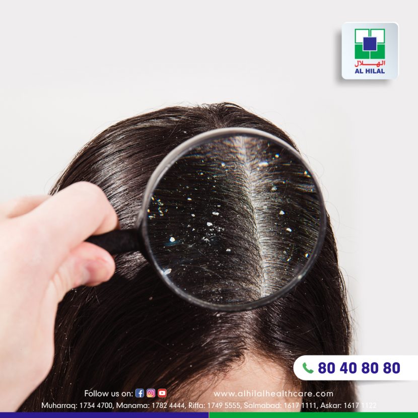 What Is Dandruff Symptoms Causes Diagnosis And Treatment 7153