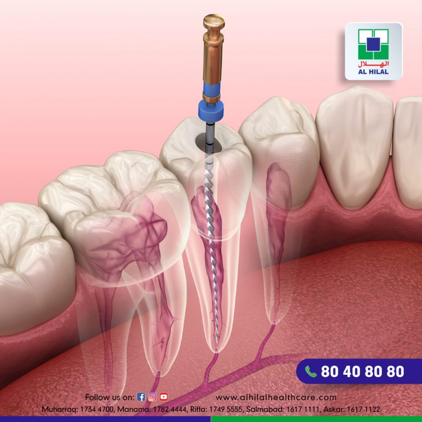 Root Canal Treatment Everything You Need To Know