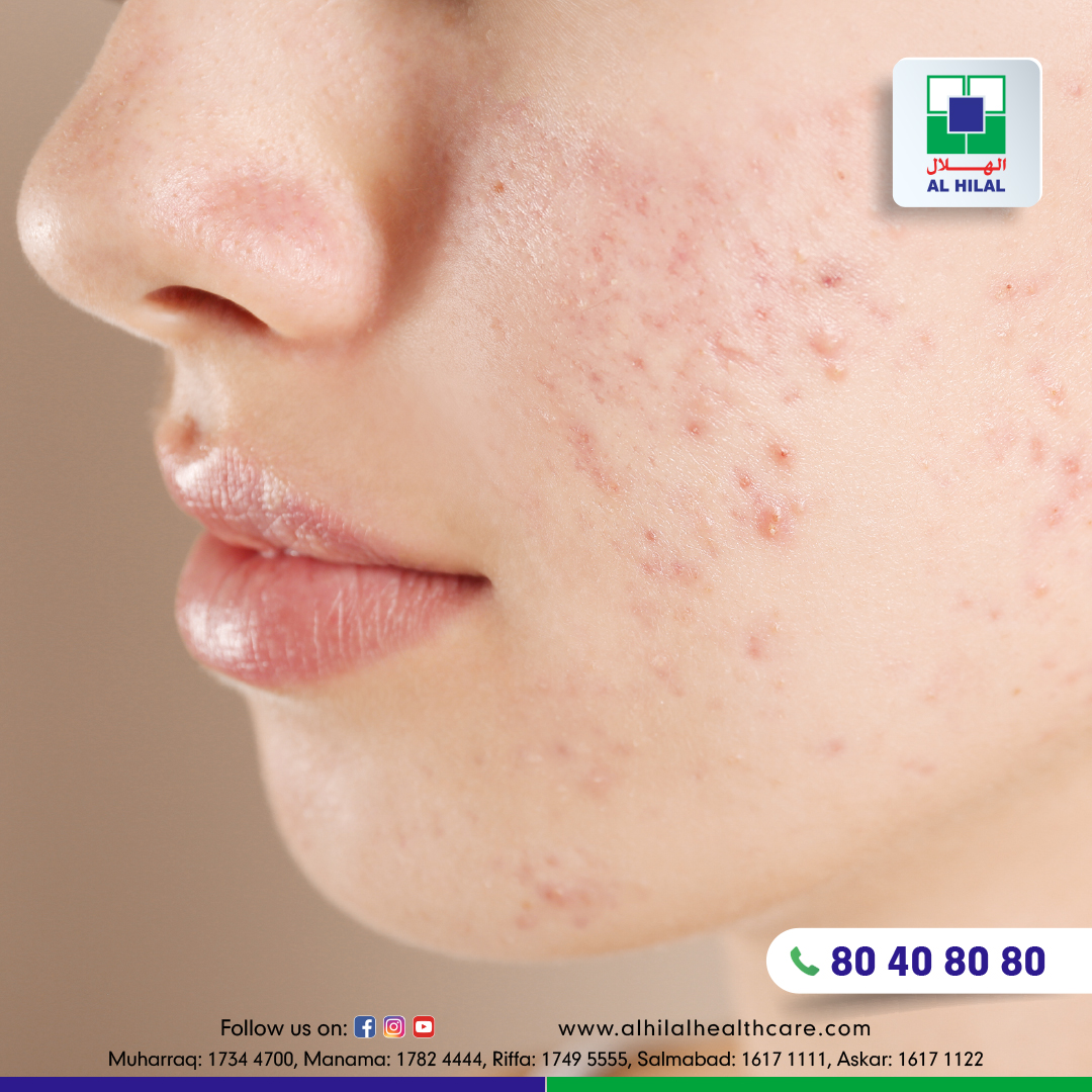 Understanding Acne Vulgaris Symptoms Causes Treatments